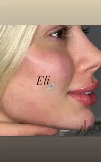 ژل لب گونه چونه زاویه خط خنده بوتاکس فقط ۴۹۹ تومان
