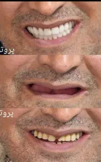 دندان مصنوعی دبل جوانان اقساط ویژه بازنشستگان
