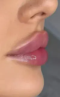 جشنواره تخفیف فیلر بادی .فیلر بیکینی ۳۵سی سی ۷۵۰۰