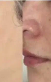 پاک کردن تاتو بدن رفع لک و خال