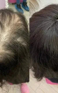 اگه از ریزش موهات کلافه شدی