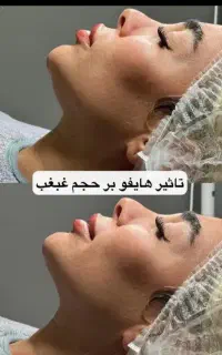 پی آر پی هایفو کربن تراپی ریمو تتو فشیال لاغری