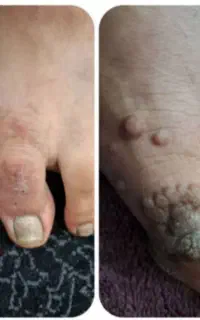 ۳ روزه زگیل ، خال و منگوله گوشتی