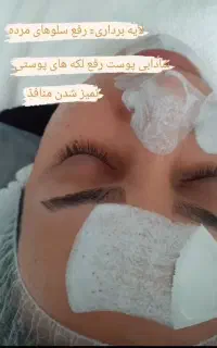 لیفت و درماپلینگ