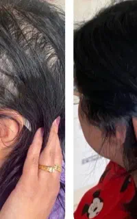 پک ریزش مو گیاهی