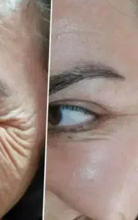 بوتاکس فیلر پی ار پی لیفت نخ تخصصی