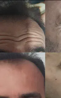 آف فیلر وبوتاکس تضمینی(خانمهاوآقایان)