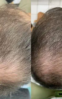 کاهش ریزش با روش نوین