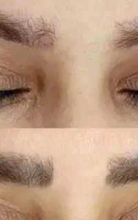 ریموو ابرو و انواع تتو با لیزر بدون هیچ زخمی