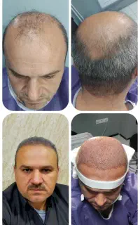 کاشت مو