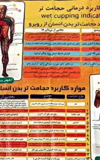 حجامت و زالو درمانی