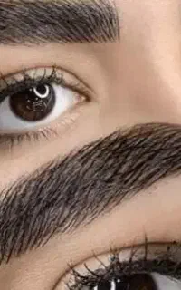 فیبروز میکرو بلیدینگ