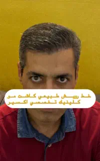 کاشت مو ابرو ریش کلینیک تخصصی اکسیر اقساطی