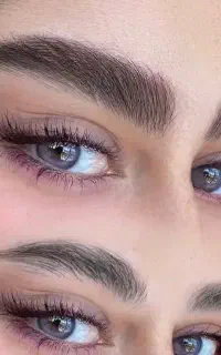 میکروبلیدینگ شیدینگ لب فیبروزهاشوراقتصادی