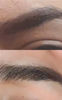 انجام میکرو بلیدینگ ابرو