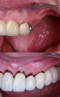 ایمپلنت قسطی و امکان استفاده از وام