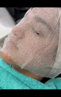 هایفو تراپی و پاکسازی پوست