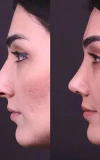عمل زیبایی بینی ۶۰ میلیون با اقساط ۱۲ماهه
