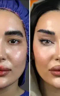 اندولیفت جراحی بلفارو پلاستی لیفت شقیقه گونه ابرو