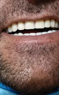 دندانسازی فرخانی .ساخت .تعمیر .تعویض دندان مصنوعی