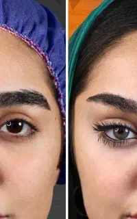 بلفاروپلاستی لیفت صورت لیفت ابرو