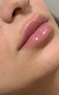 مدل ژل لب و بوتاکس با هزینه مواد،کات گونه،چانه
