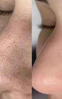 همکاری با دستیار پاکسازی پوست (درصدی ۷۰/۳۰)