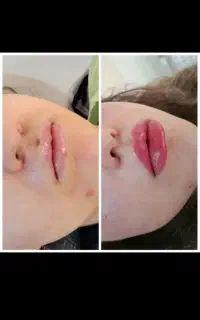 تزریق فیلر،بوتاکس باتخفیف ۷۰درصد در کلینیک۱۷شهریور