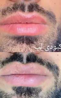 روشن سازی لب نچرال ، اسکالپ سر ، فیبروز ابرو نچرال