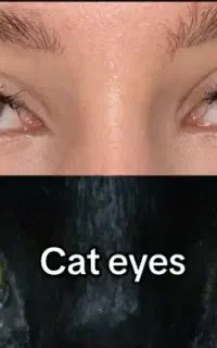 بوتاکس صورت و تعریق زیربغل، لیفت ابرو، تخفیف ویژه