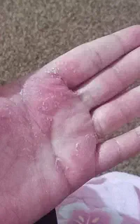 پسوریازیس و اگزما