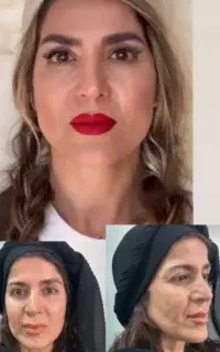 سوپر لیفت ابرو شقیقه و صورت در ۲۰دقیقه توسط پزشک