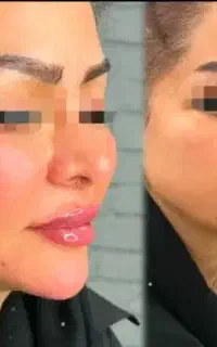 تخفیف فیلر تزریق ژل و بوتاکس