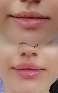 لیزر موهای زائد و جوانسازی،مراغه