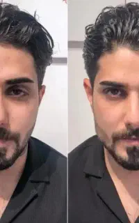 آف ۵۰٪فیلر وژل از790و بوتاکس وPRP(تزریق توسط پزشک)