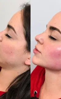 خدمات وآموزش تزریق ژل بوتاکس مزوتراپی در منزل