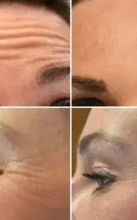 تخفیف ویژه برداشت انواع خال و تزریق بوتاکس مصبورت