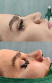 عمل بینی ۳۸ تومن صفر تا صد