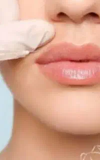 مدل  تزریق ژل لب و بوتاکس