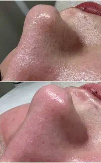 پاکسازی، فیشیال تخصصی