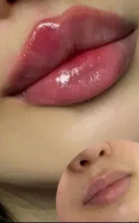 جشنواره ی تخصصی فیلر وبوتاکس