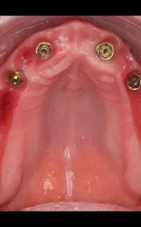 جشنواره ویژه ایمپلنت و دندانپزشکی بااقساط پنج ساله