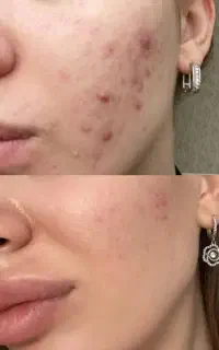 پماد اورجینال بیومم.تیک شارژ شد