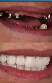 روکش ایمپلنت اقساطی فقط ۱۰م تومان