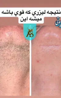 لیزر مو زائد مادام العمر و تضمینی مایا بیوتی