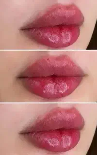 پی آر پی لاغری ریمو تتو مزوژل هایفو کربن تراپی