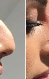 زیبایی نیلگون تخفیف میکروبلیدینگ،فیبروز،فیلر(ژل)