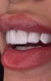 کامپوزیت/لمینیت بدون تراش بااقساط ویژه