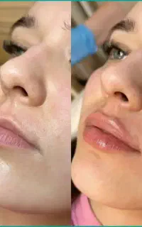 بوتاکس و فیلر