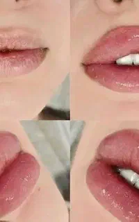 تخفیف بر روی تمامی تزریقات زیبایی ژل ،بوتاکس وغیره